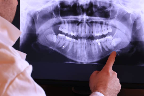 Best Emergency Wisdom Teeth Removal in Emporia, KS